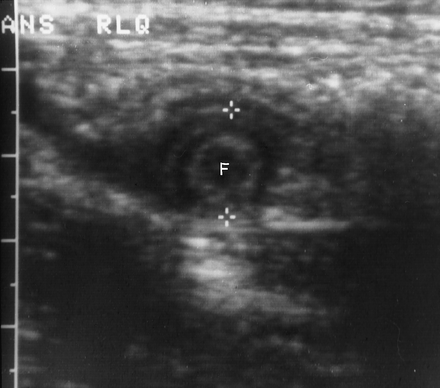 Featured image of post Radiopaedia Appendicitis Ultrasound Appendicitis is inflammation of the vermiform appendix